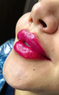 فیلر لب / تزریق ژل با فقط سی سی ۹۸۰توسط پزشک