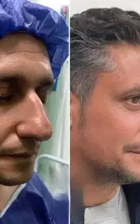 جراحی بینی با ضمانت نامه کتبی کیفیت