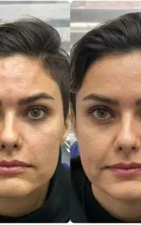 ژل و بوتاکس و مزوتراپی فیلر بادی با تخفیف ویژه