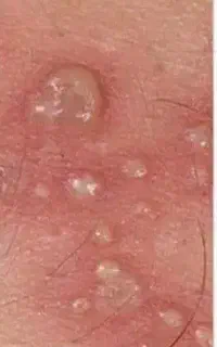 جلوگیری از سرطانی شدن زگیل