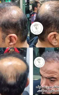کاشت مو و ابرو ریش تیم شیرازی اقساط در سنندج