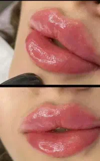 بشتابیدبشتابید تخفیف عید ژل بوتاکس فیلر بادی