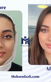 عمل بینی با شرایط ویژه (مشاوره رایگان)