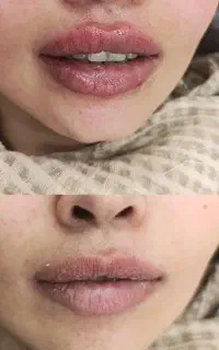 جشنواره ژل ، بوتاکس،مزو درمانگاه البرز شرایط ویژه