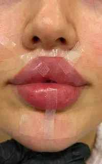 آف ویژه ژل بوتاکس جوانساز پوست