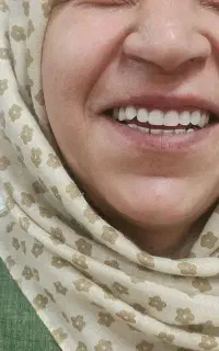 دندان خراب رو جایگزین کن