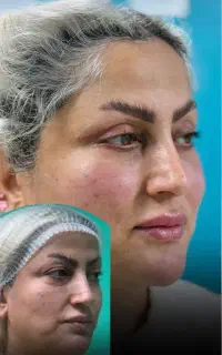 بلفارو پلاستی پلک بالا و پایین