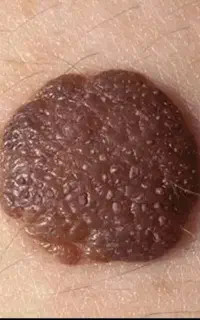 زگیل تناسلی با لیزر زیگیل اچ پی وی HPV درمان زائده