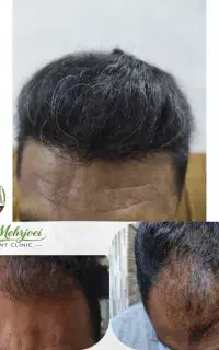 کاشت وترمیم موبابالاترین کیفیت باشرایط ویژه اقساطی