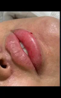 فیلر و بوتاکس