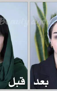 عملMACS LiFT/لیفت صورت/بلفارو/جوانسازی