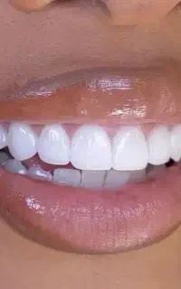 بازسازی لبخندباتکنولوژی روزاقساط بدون بهره درتبریز