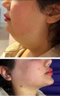 پیکرتراشی و ژنیکوماستی مردان و ماموپلاستی