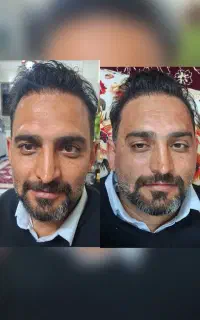 تخفیف 30درصد پی ار پی  ژل بوتاکس فیلر فقط دو روز