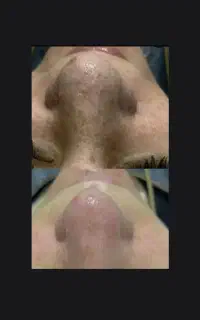 پاکسازی عمیق پوست، برداشتن خال زگیل، رنگ مو