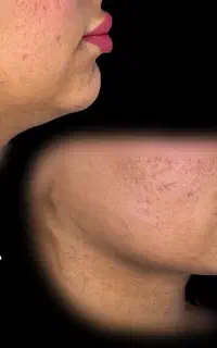 تزریق چربی  بلفاروپلاستی  ساکشن غبغب