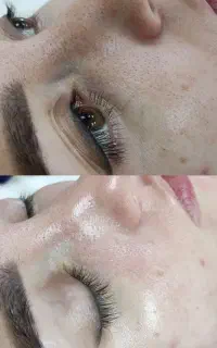 پاکسازی و فیشیال تخصصی پوست صورت