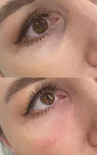 آموزش تزریق ژل و بوتاکس