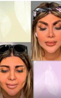 انواع جراحی صورت و ژل در کیلنیک آرییل