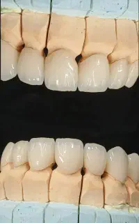 قالب ریز و پیک دندان سازی