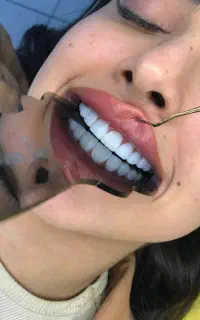کامپوزیت کن با متریال عالی بااقساط