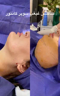 جشنواره بلفاروپلاستی و ساکشن غبغب در کلینیک دریا