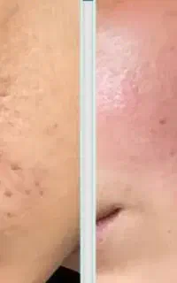 اف لیزر فوتونا به مناسبت  روز دختر