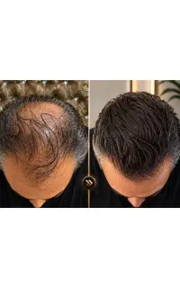 دوره مزو و کاشت تموم شده