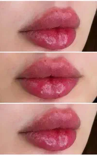 ژل و بوتاکس فیلرلب کانتورینگ مزوژل توسط پزشک۸۵۰
