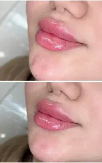 تزریق فیلر و بوتاکس
