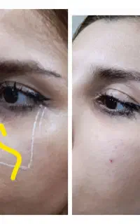 فیلر،بوتاکس،ومزوتراپی و.. اقساطی