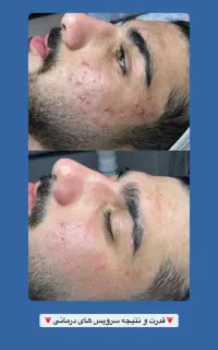 فیشیال پوست و درمان شوره و ریزش مو