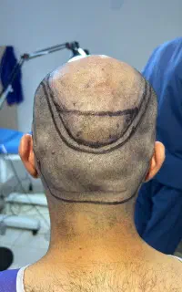 آموزش کاشت مو،ابرو و ریش