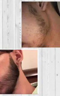 ریش نداری این محلول برای توعه