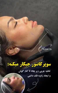 ساکشن غبغب(وی لاین)/بوکالفت/بلفاروپلاستی