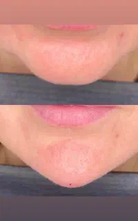 تزریق فیلر ‌و بوتاکس