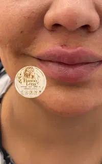 فیلر صورت بوتاکس انزیم صورت و بدن