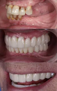 دندانپزشکی ایمپلنت کره ۱۳ تومن با وام