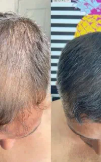 ریزش را متوقف کن رویش رو چند برابر کن