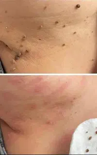 خالبرداری زیرنظر پزشک رایگان برداشته میشود