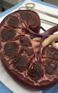 بهبود قطعی سنگ کلیه