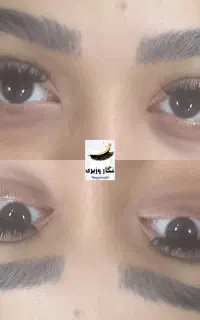 کاشت مژه هیدن