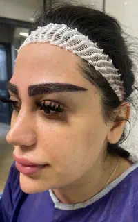 کاشت  تخصصی مو ،ابرو،ریش vip
