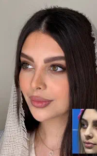 عمل جراحی بینی به سبک پیزوسرجری و تخفیف ۵۰درصد