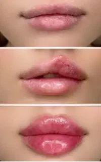 ژل فیلر بوتاکس