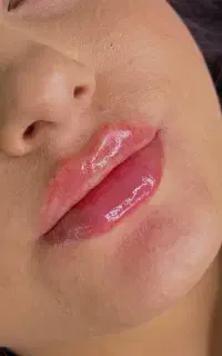 تزریق فیلر صورت و بوتاکس فرصت محدود