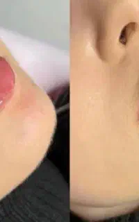 تزریق فیلر وبوتاکس وجوانساز