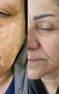 صافی مو کراتین وپروتین وخال برداری