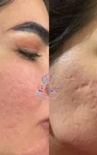 پی آرپی مزونیدلینگ سابسیژن مزوتراپی لک جای جوش