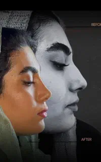 عمل زیبایی بینی / ۲نوبت خالی اخر هفته/۳۵ت